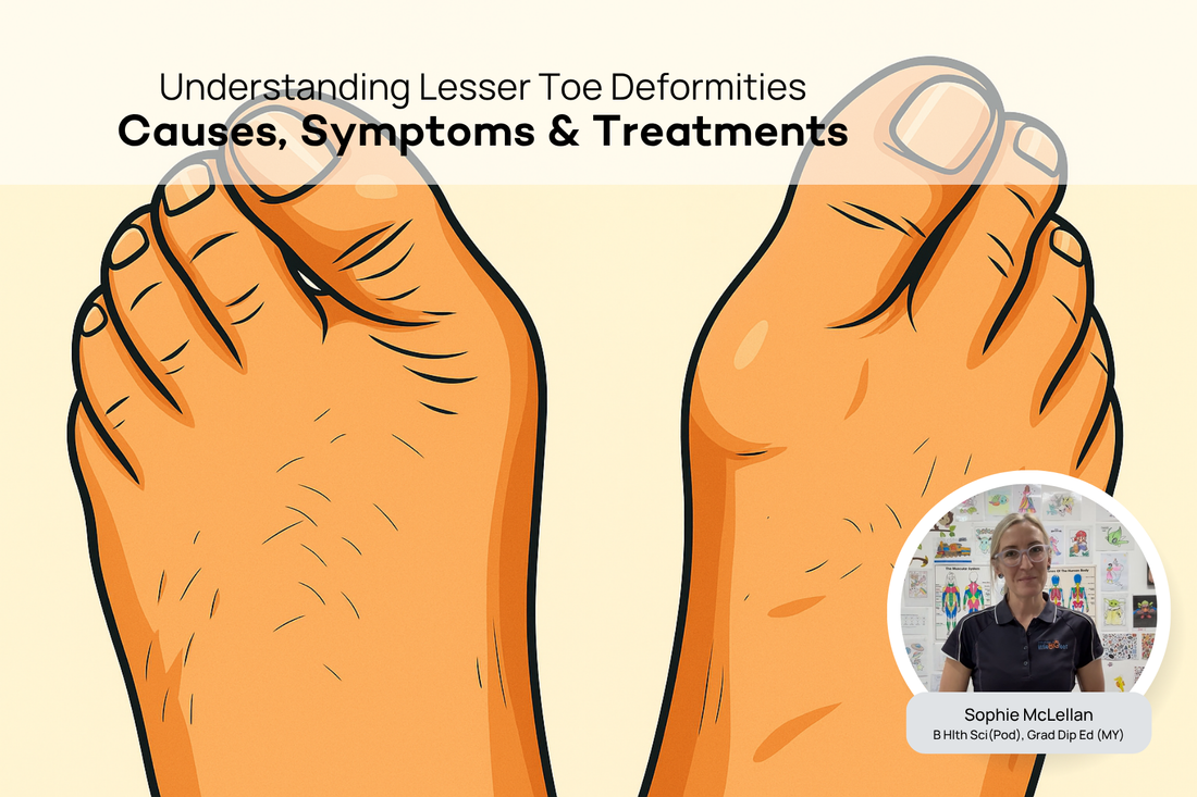 What are Lesser Toe Deformities? A Podiatrist Explains the Causes and Treatment
